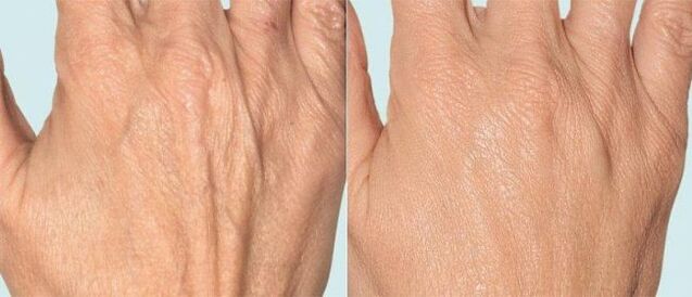 Peau des mains avant et après la thérapie fractionnée
