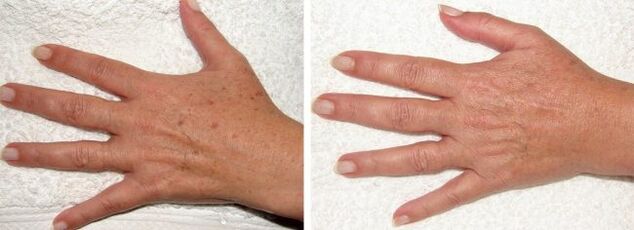 Résultat de l'élimination des taches pigmentaires sur les mains