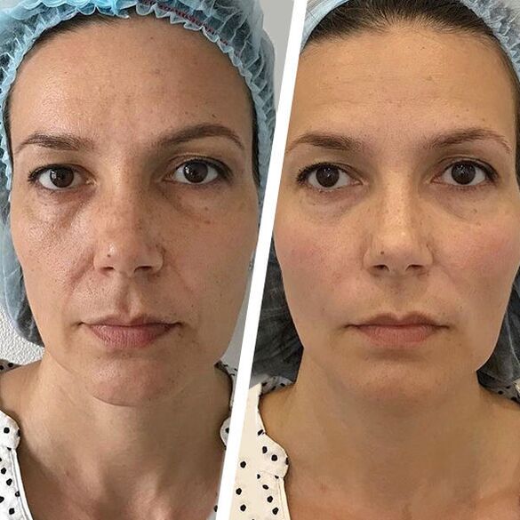 photo de visage avant et après rajeunissement laser